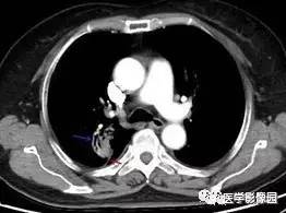 【病例】右肺上叶腺癌1例CT 【病例】右肺上叶腺癌1例CT