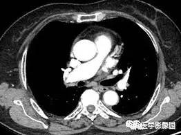 【病例】右肺上叶腺癌1例CT 【病例】右肺上叶腺癌1例CT