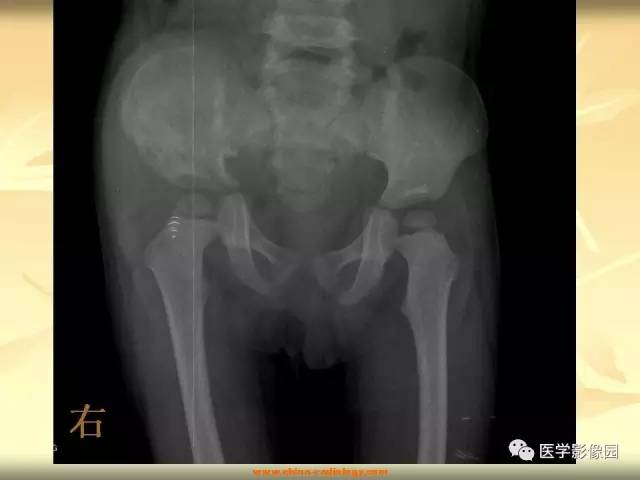 【病例】右侧髂骨原始神经外胚层肿瘤1例X线CT及MR影像表现