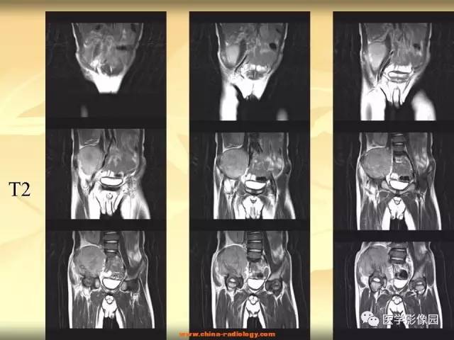 【病例】右侧髂骨原始神经外胚层肿瘤1例X线CT及MR影像表现 【病例】右侧髂骨原始神经外胚层肿瘤1例X线CT及MR影像表现