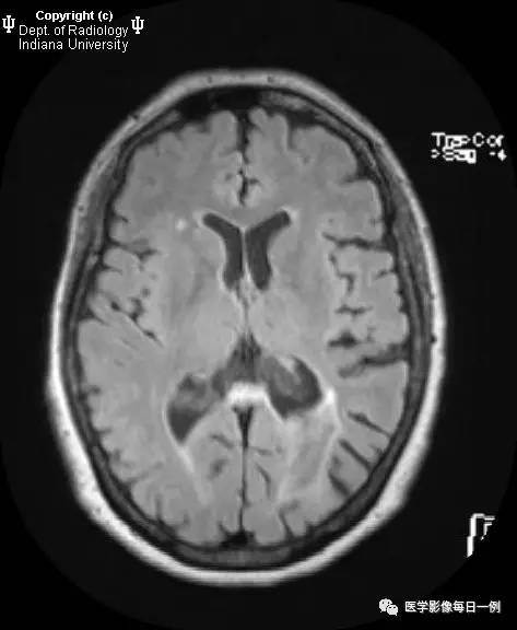 【病例】脑淀粉样变性1例MR影像表现 【病例】脑淀粉样变性1例MR影像表现