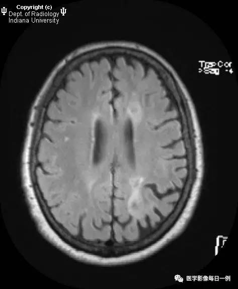 【病例】脑淀粉样变性1例MR影像表现 【病例】脑淀粉样变性1例MR影像表现