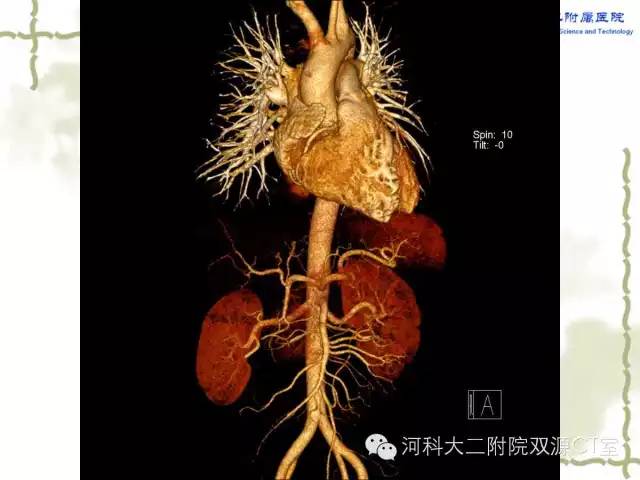 【PPT】循环系统影像学之——主动脉疾病