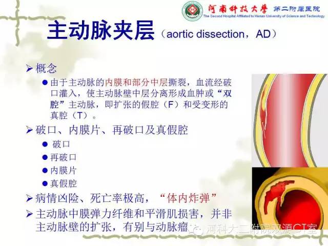 【PPT】循环系统影像学之——主动脉疾病
