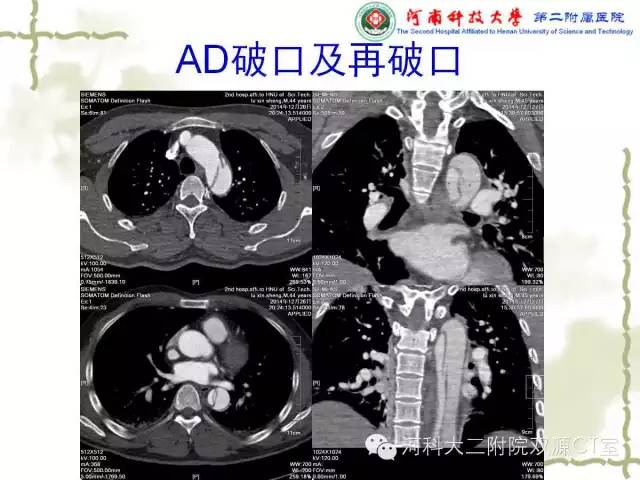 【PPT】循环系统影像学之——主动脉疾病