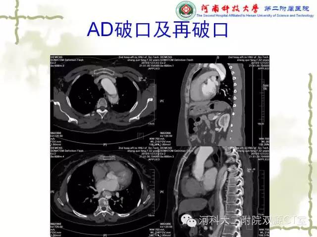 【PPT】循环系统影像学之——主动脉疾病