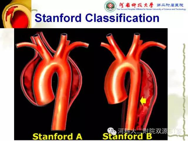 【PPT】循环系统影像学之——主动脉疾病