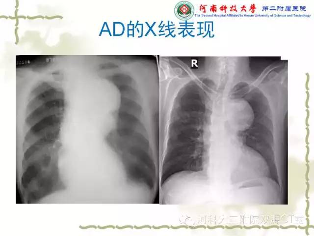 【PPT】循环系统影像学之——主动脉疾病