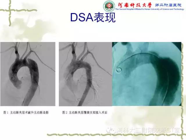 【PPT】循环系统影像学之——主动脉疾病
