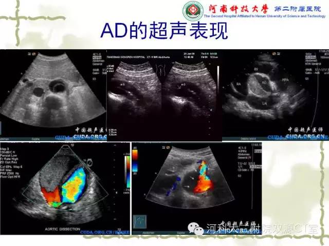【PPT】循环系统影像学之——主动脉疾病