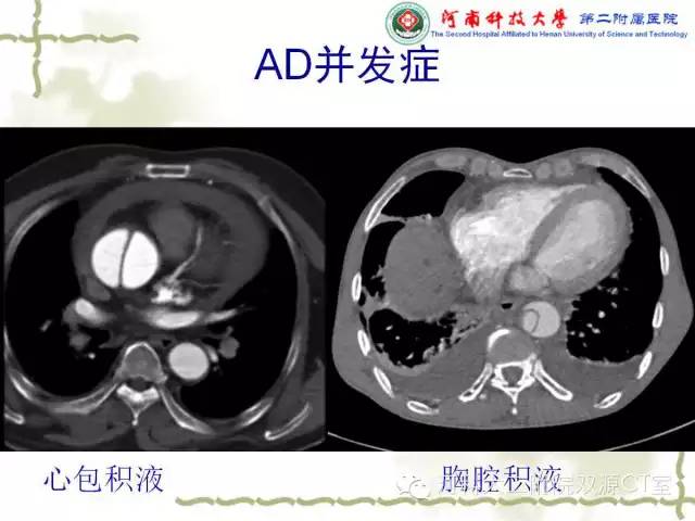 【PPT】循环系统影像学之——主动脉疾病