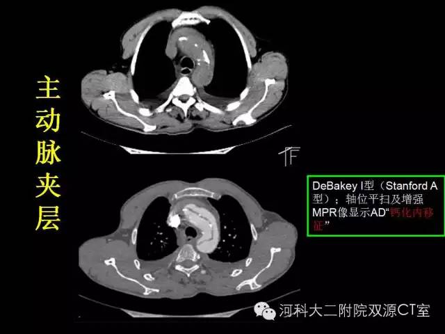 【PPT】循环系统影像学之——主动脉疾病