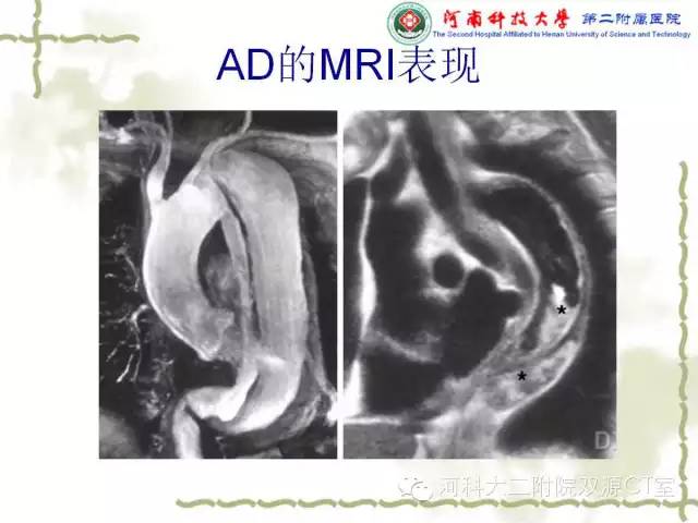 【PPT】循环系统影像学之——主动脉疾病