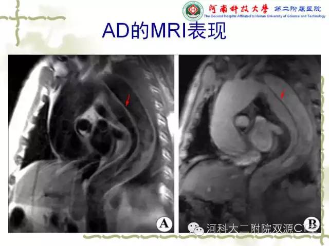 【PPT】循环系统影像学之——主动脉疾病