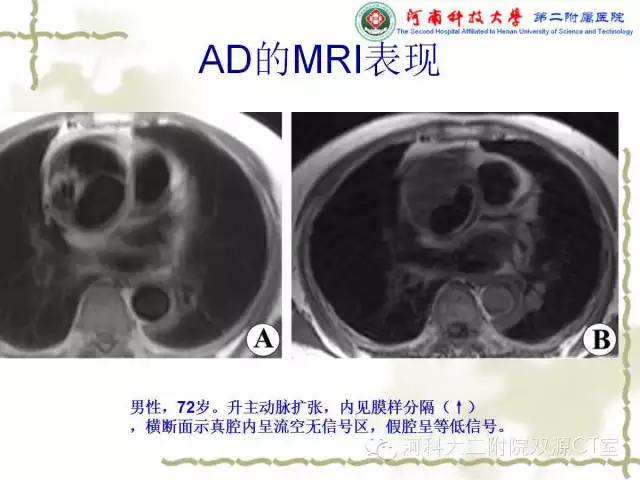 【PPT】循环系统影像学之——主动脉疾病