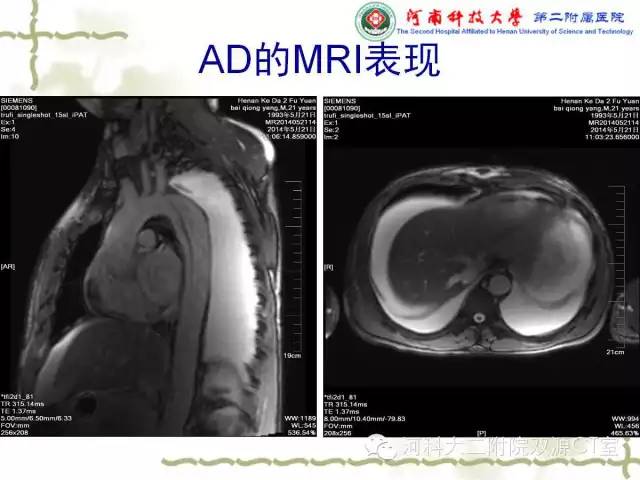 【PPT】循环系统影像学之——主动脉疾病