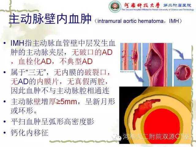 【PPT】循环系统影像学之——主动脉疾病