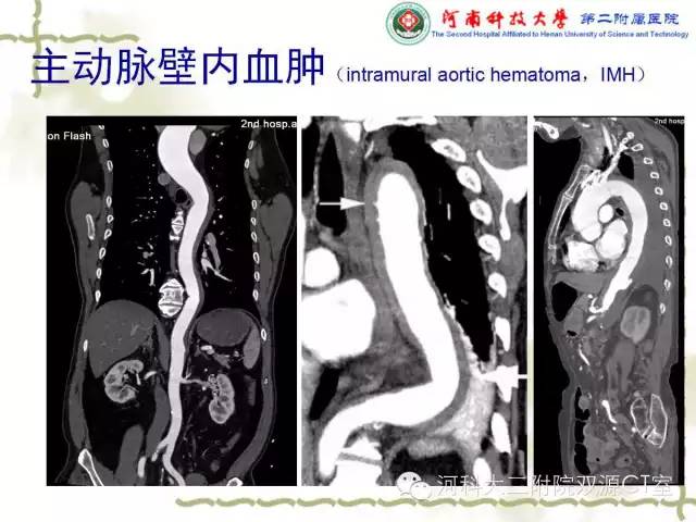 【PPT】循环系统影像学之——主动脉疾病