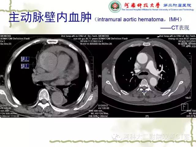 【PPT】循环系统影像学之——主动脉疾病