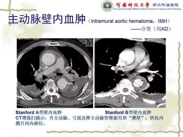 【PPT】循环系统影像学之——主动脉疾病