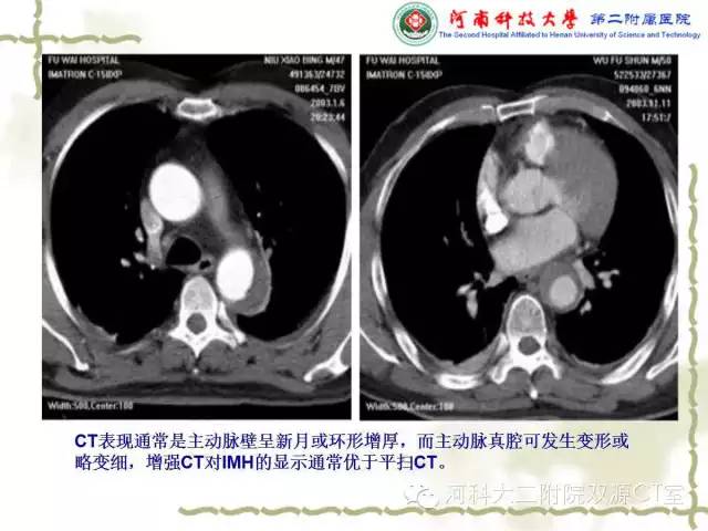【PPT】循环系统影像学之——主动脉疾病