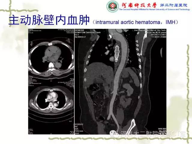 【PPT】循环系统影像学之——主动脉疾病