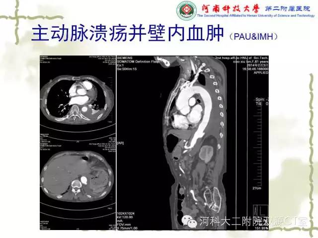 【PPT】循环系统影像学之——主动脉疾病