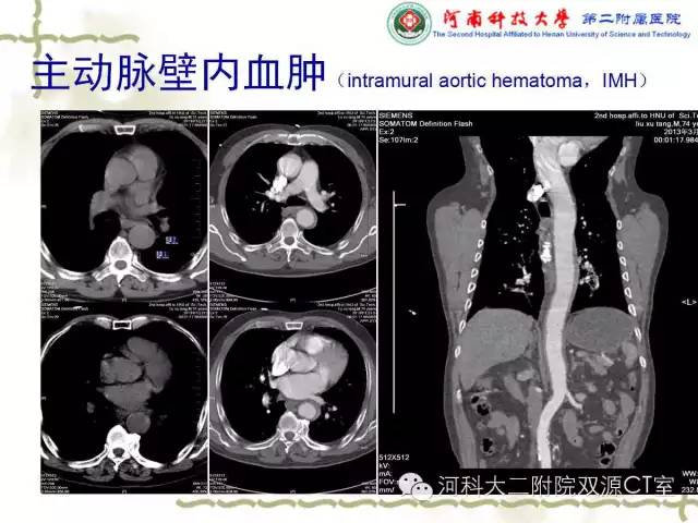【PPT】循环系统影像学之——主动脉疾病