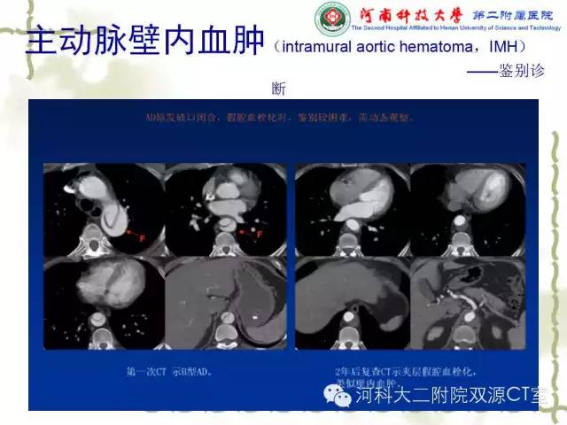 【PPT】循环系统影像学之——主动脉疾病