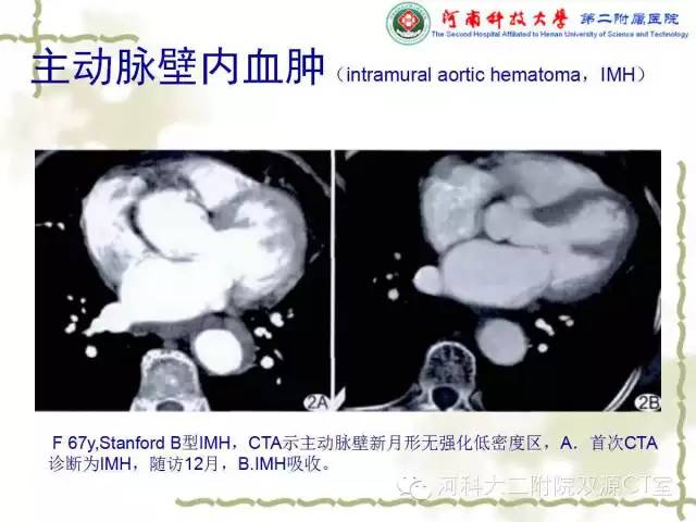【PPT】循环系统影像学之——主动脉疾病