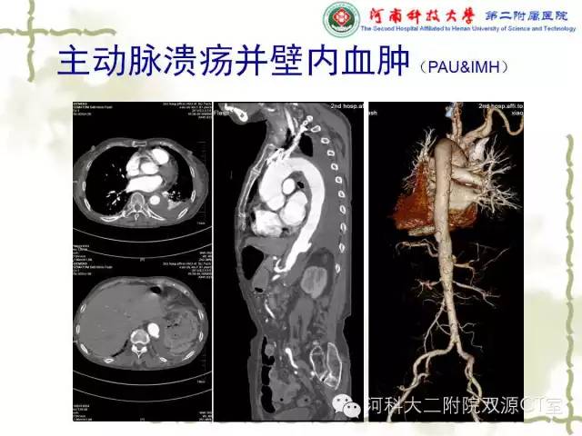 【PPT】循环系统影像学之——主动脉疾病