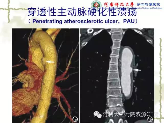 【PPT】循环系统影像学之——主动脉疾病