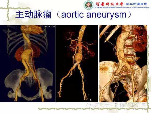 【PPT】循环系统影像学之——主动脉疾病