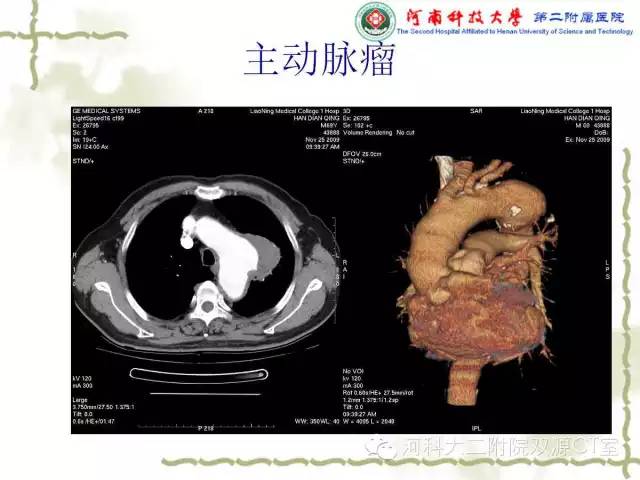 【PPT】循环系统影像学之——主动脉疾病