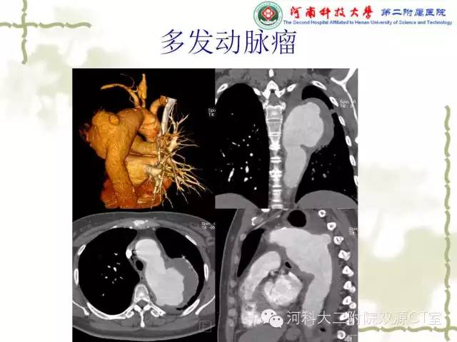 【PPT】循环系统影像学之——主动脉疾病