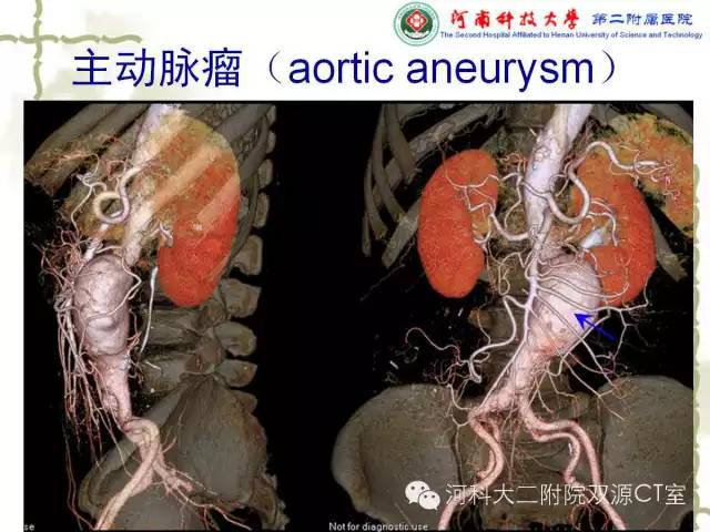 【PPT】循环系统影像学之——主动脉疾病