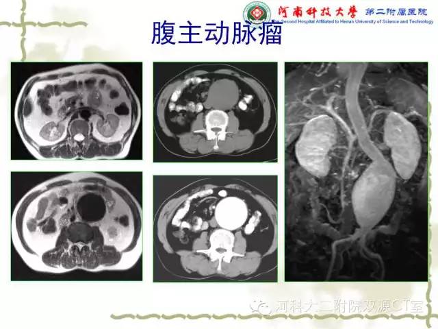 【PPT】循环系统影像学之——主动脉疾病