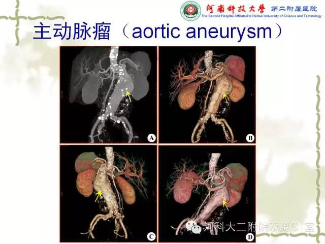 【PPT】循环系统影像学之——主动脉疾病
