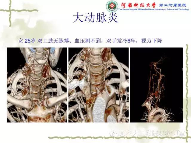 【PPT】循环系统影像学之——主动脉疾病
