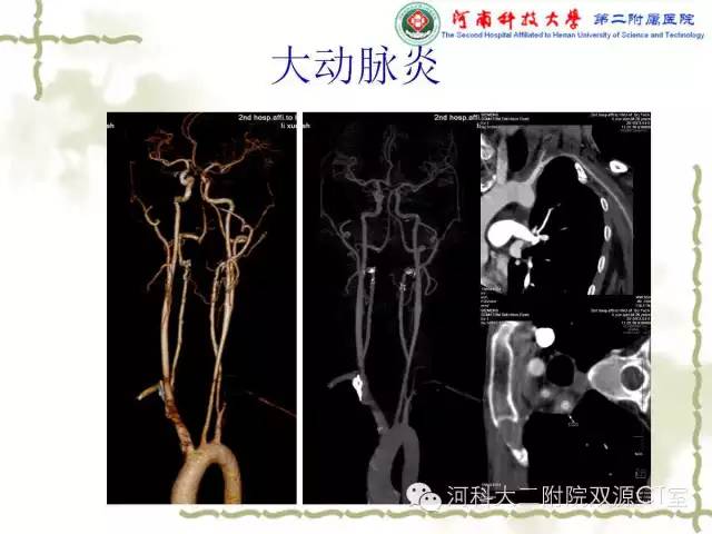 【PPT】循环系统影像学之——主动脉疾病