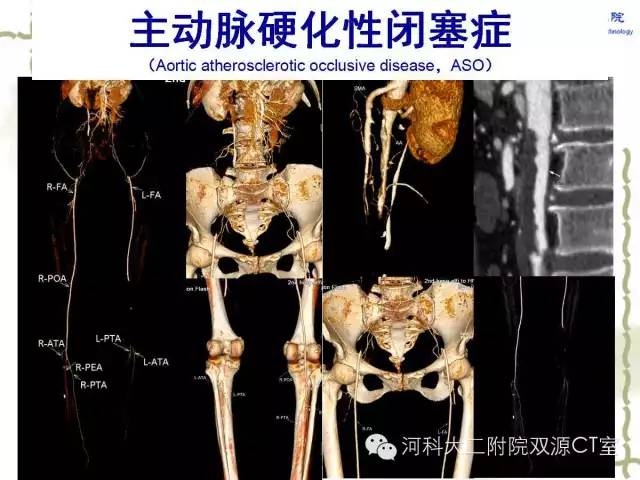 【PPT】循环系统影像学之——主动脉疾病