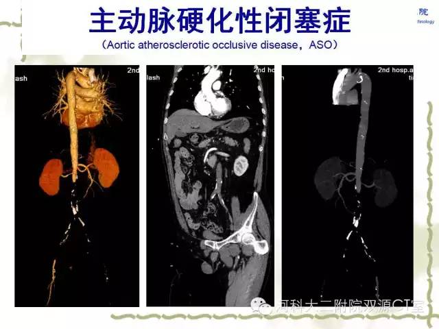 【PPT】循环系统影像学之——主动脉疾病