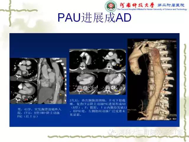 【PPT】循环系统影像学之——主动脉疾病