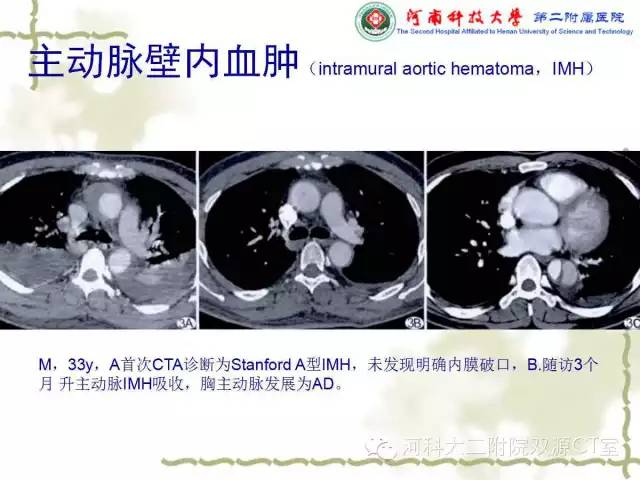 【PPT】循环系统影像学之——主动脉疾病