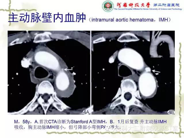 【PPT】循环系统影像学之——主动脉疾病
