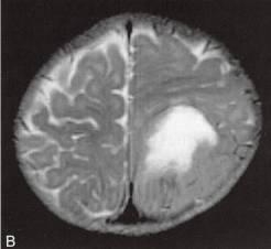【病例】脑实质内室管膜瘤1例MR影像表现 【病例】脑实质内室管膜瘤1例MR影像表现