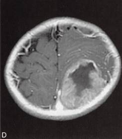 【病例】脑实质内室管膜瘤1例MR影像表现 【病例】脑实质内室管膜瘤1例MR影像表现