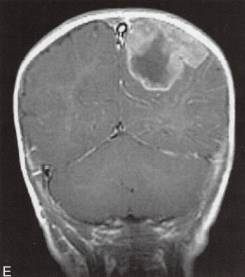 【病例】脑实质内室管膜瘤1例MR影像表现 【病例】脑实质内室管膜瘤1例MR影像表现
