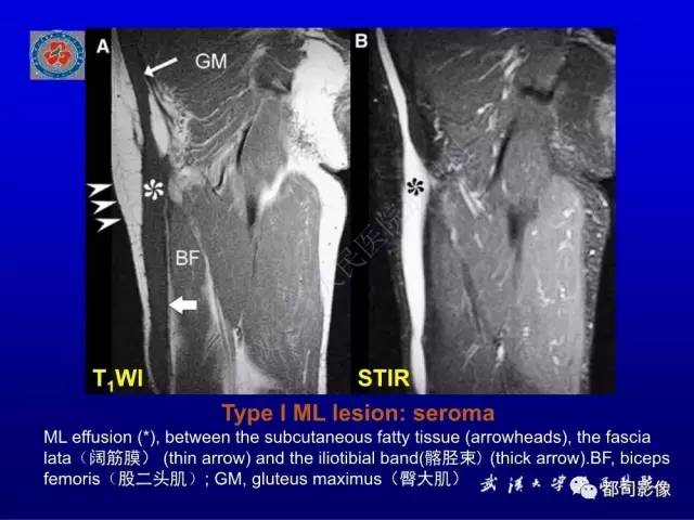 【PPT】含液-液平面软组织病变影像诊断