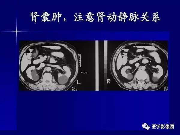 【PPT】肾脏常见病变的CT诊断